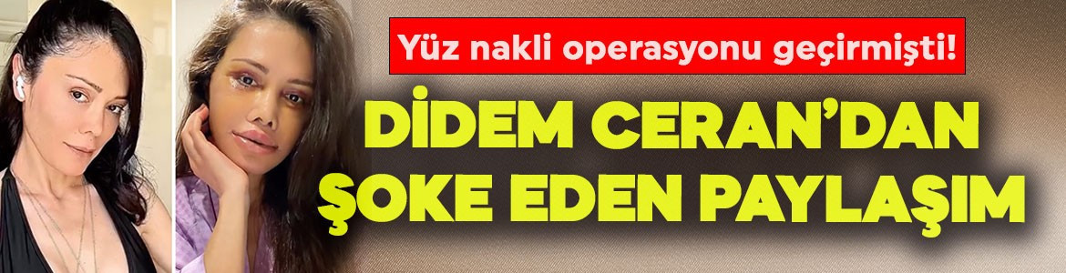 Yüz nakli operasyonu geçirmişti! Didem Ceran'dan şaşkınlığa sürükleyen paylaşım