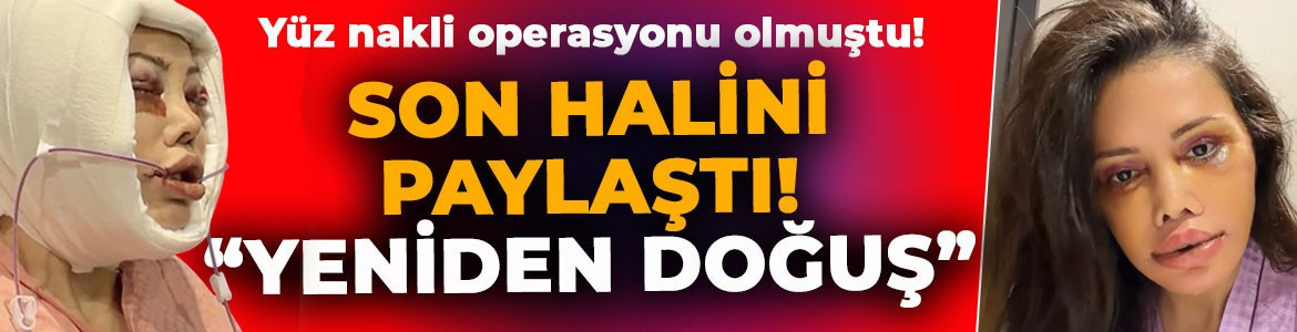 Yüz nakli operasyonu olmuştu! Didem Ceran son halini paylaştı: Estetik değil, yeniden doğuş!