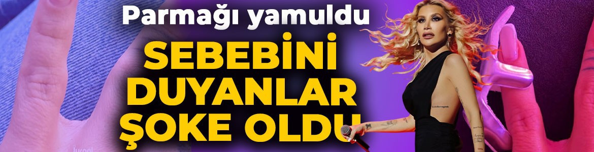 İrem Derici'nin parmağı yamuldu! Nedenini duyanlar şaştı kaldı