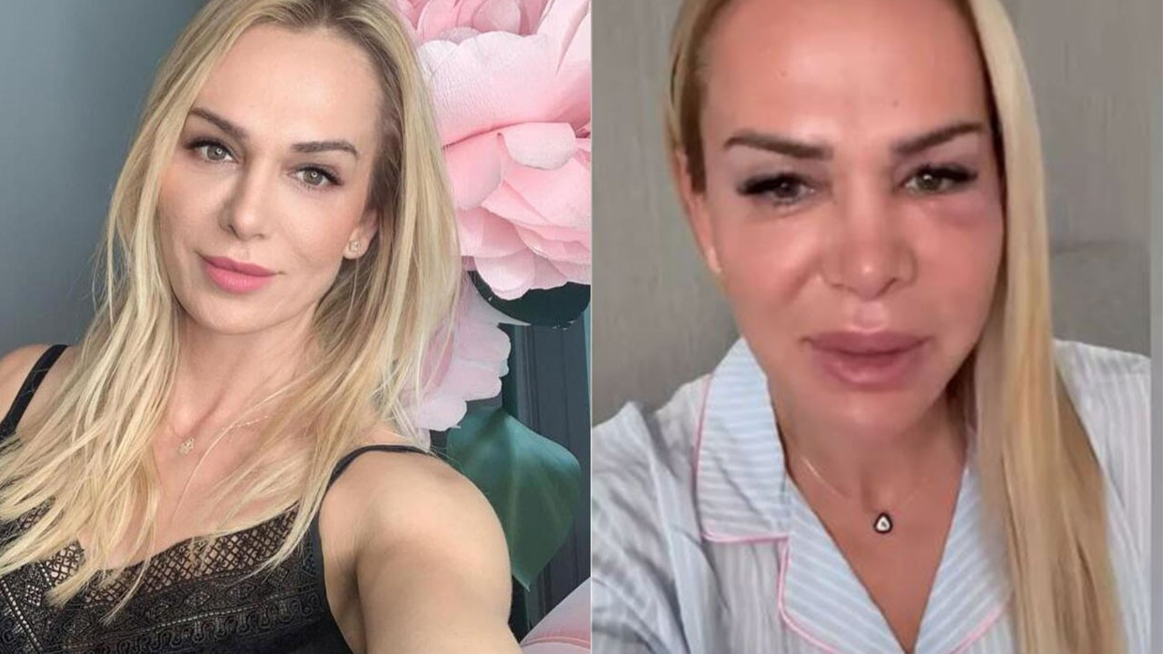 Yüzü gözü morarmıştı! Survivor Nagihan Karadere darp mı edildi? Sosyal medya hesabından açıkladı