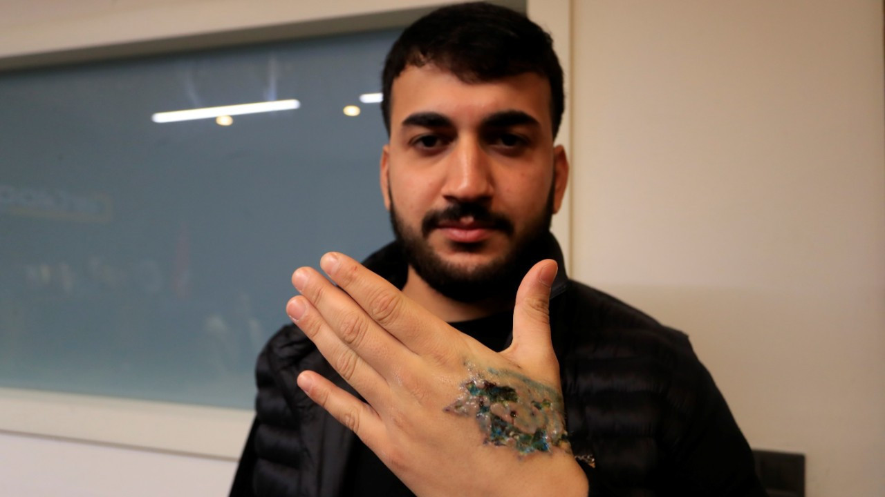 Dövme sildirmek isterken elinden oluyordu! Aldığı cevap şok etti