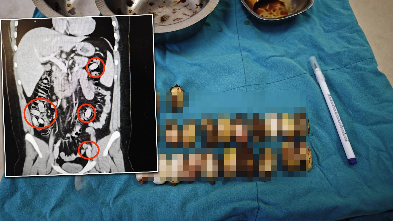 Röntgende ortaya çıktı! Midesinden çıkanlar şoke etti