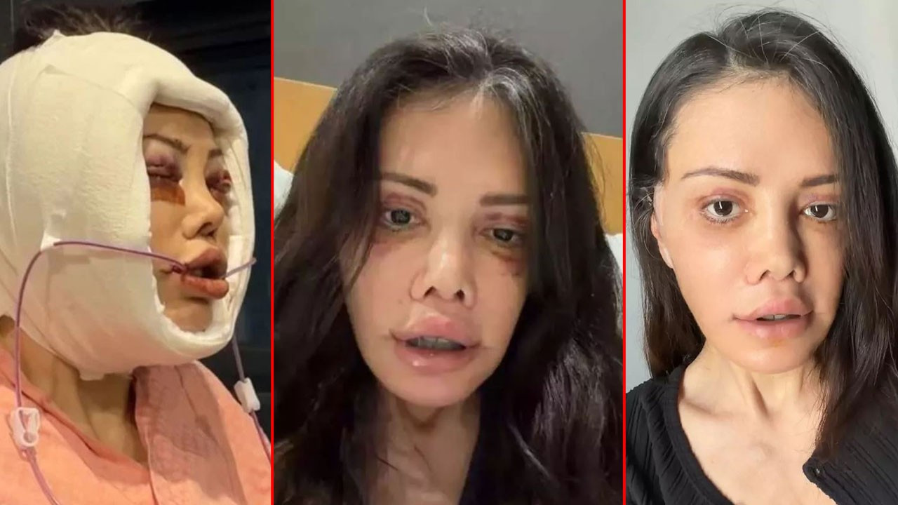 Yüz nakli operasyonu geçirmişti! Didem Ceran'dan şaşkınlığa sürükleyen paylaşım