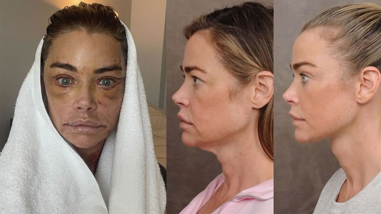 Ünlü oyuncu estetik operasyonu sonrası değişimiyle şoke etti! Son halini sosyal medya hesabından paylaştı