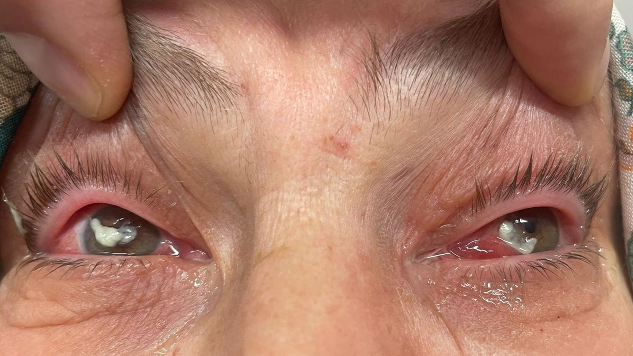 Kör eden ot!  "Gözlerine suyunu damlattı, göremez hale geldi" Uzmanlar uyardı: Önermiyoruz!