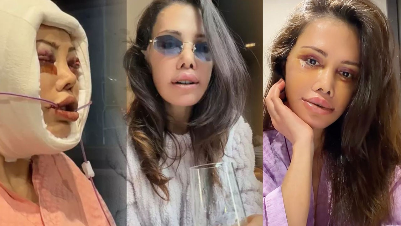 Yüz nakli operasyonu geçiren Didem Ceran'ın son hali olay oldu: "Bebeksiyim, yapay zeka değil"