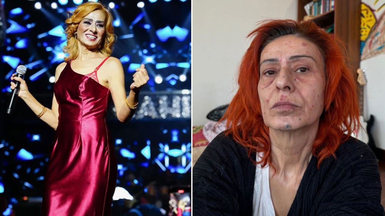 Yüzünde kimyasal yanık oluşmuştu! Yıldız Tilbe artık saçlarında 4 malzeme kullanıyor: Formülü verdi