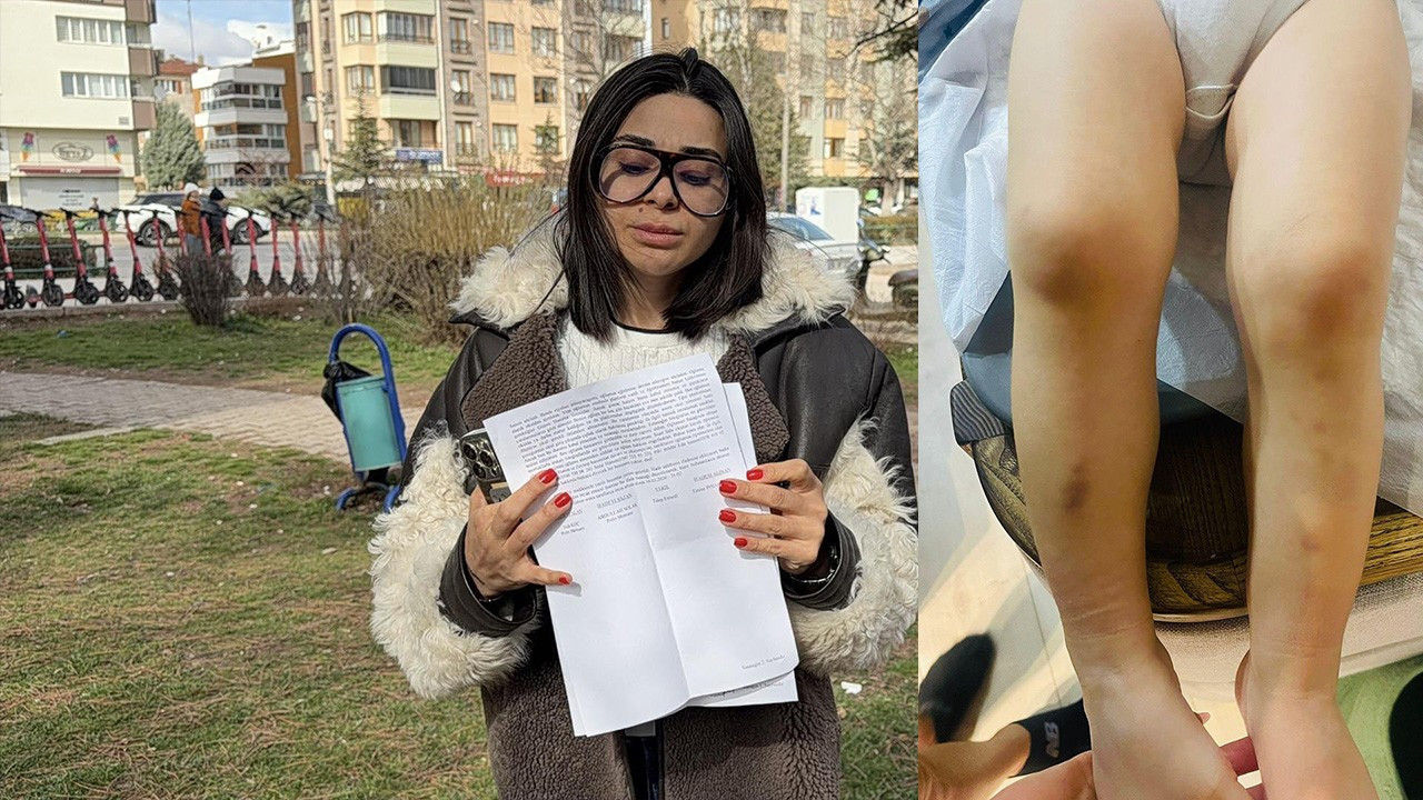 Kreşte darp iddiası! 2 yaşındaki çocuğa eve morluk…