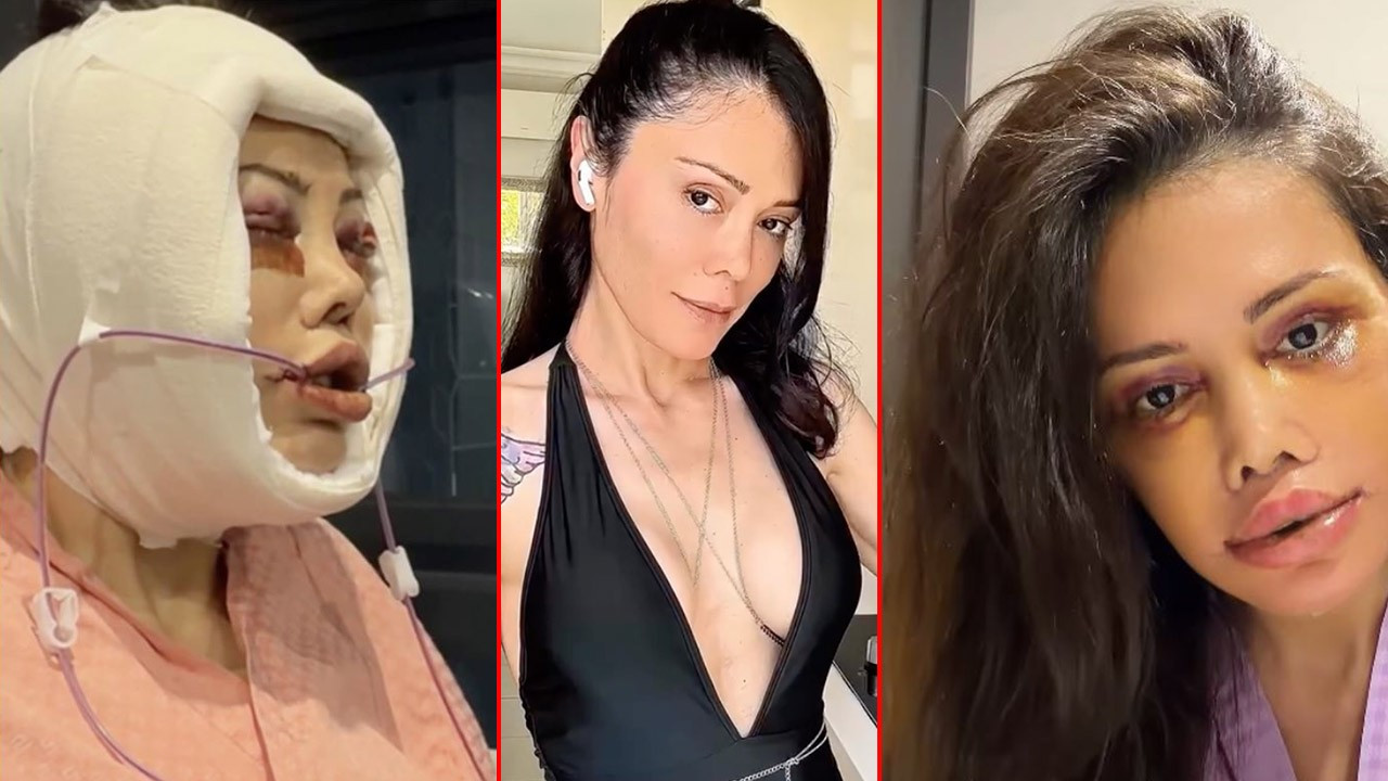 Yüz nakli operasyonu geçirmişti! Didem Ceran'ın son hali sosyal medyayı ikiye böldü