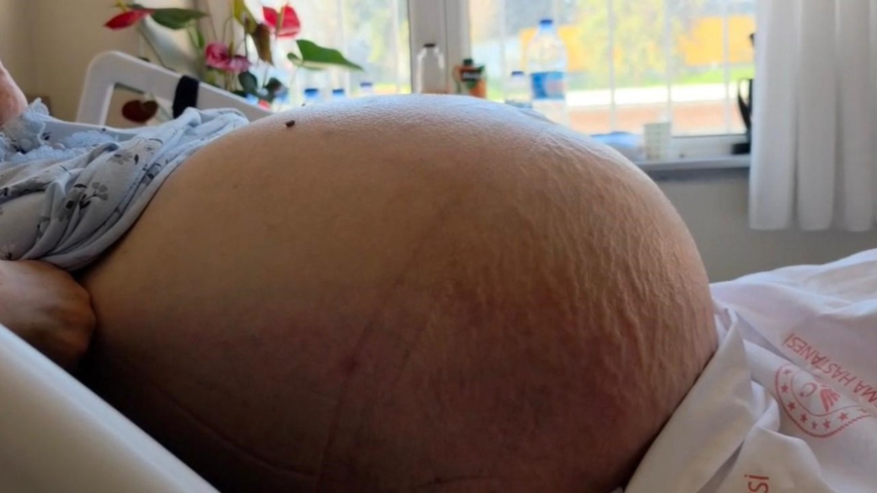 Doktorlar bile şaşırdı: Kabızlık sandı, 22 kiloluk tümör çıktı!