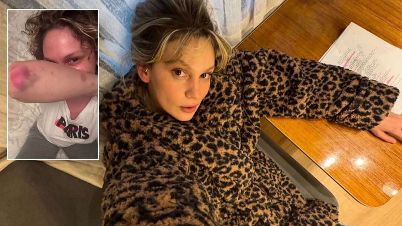 Farah Zeynep Abdullah'ın paylaşımı korkuttu! Vücudundaki morluklar dikkat çekti