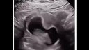 Ultrasondaki bebeğin görüntüsü şaşkına çevirdi