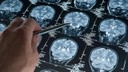 Alzheimer araştırmalarında yeni keşif!
