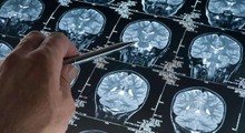 Son Dakika: Alzheimer araştırmalarında yeni keşif!