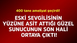 400 tane ameliyat geçirdi. Eski sevgilisinin yüzüne asit attığı güzel sunucunun son hali ortaya çıktı