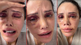 Yüz naklinin ardından revizyon ameliyatı olmuştu! Didem Ceran gözyaşları içerisinde isyan etti: "CİMER'e şikayet etmişler"