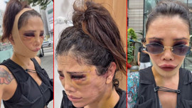 Yüz naklinin ardından revizyon ameliyatı olmuştu! Didem Ceran estetiği doyamadı: Bu kez Kim Kardashian estetiği yaptıracak!