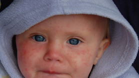 Avrupa'da kızamık alarmı! İstanbul'da risk var mı? İl Sağlık Müdürü Doç. Dr. Abdullah Emre Güner tehlike durumunu açıkladı