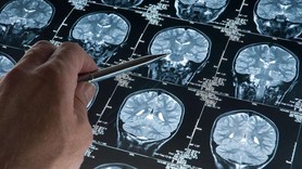 Alzheimer araştırmalarında yeni keşif: Riski artıran genetik varyant bulundu!