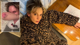 Farah Zeynep Abdullah'ın paylaşımı korkuttu! Vücudundaki morluklar dikkat çekti