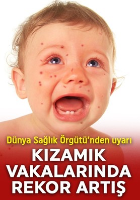 DSÖ'den Avrupa'da kızamık uyarısı! 27 yıl sonra en yüksek vaka görüldü