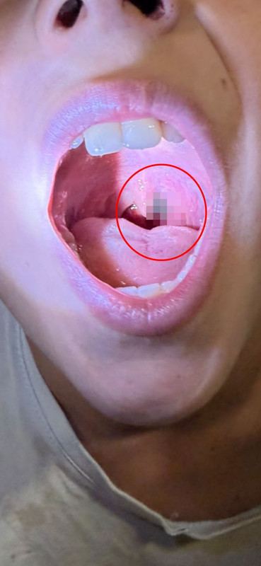 Bademcik diye gitti, doktor görünce şoke oldu! Çocuğun boğazından sülük çıktı - Resim: 8