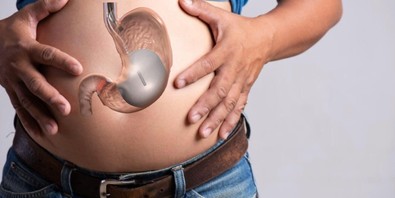 Mide balonu nedir? Mide balonu nasıl yapılır? Mide balonu işlemini kimler tercih etmelidir? - Resim : 2