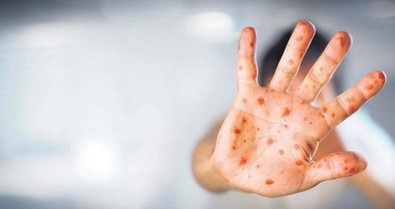Türkiye'de ilk maymun çiçeği vakası görüldü! Maymun çiçeği Türkiye'de nerede görüldü? Maymun çiçeği virüsü nedir, bulaşıcı mı? Maymun çiçeği hastalığı belirtileri nedir? - Resim : 1
