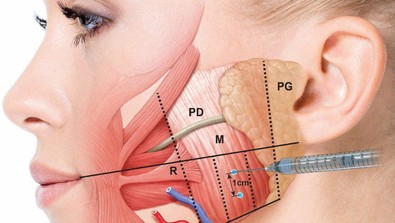Diş gıcırdatma hastalığında çene botoksu tedavisi! Masseter botoksu (Çene botoksu) nedir? - Resim : 1