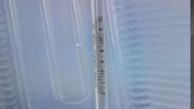 Cinsel zevk az kalsın öldürüyordu! Mesanesinden çıkanlar doktorların bile tüylerini ürpertti! - Resim : 1