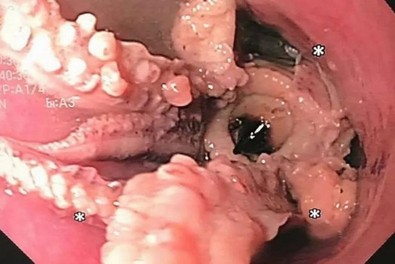 Yemekten kısa bir süre sonra yutkunamayan adam acil hastaneye gitti. Doktor adamın boğazındaki şeyi görünce kalakaldı. Çiğnemeden, bütün halde yutmuş - Resim : 2