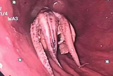 Yemekten kısa bir süre sonra yutkunamayan adam acil hastaneye gitti. Doktor adamın boğazındaki şeyi görünce kalakaldı. Çiğnemeden, bütün halde yutmuş - Resim : 1