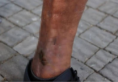 İyileşmek için yaptırdığı tedavi kabusu oldu! "2 aydır çalışamıyorum" - Resim : 1