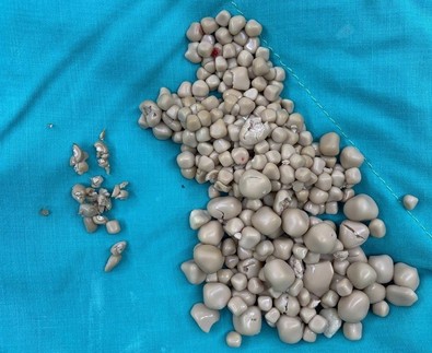 Sırt ağrısıyla hastaneye giden genç kadının röntgenini gören doktor, genç kızı anında ameliyata aldı. Genç kızın vücudundan yüzlercesi bir anda çıktı - Resim : 1