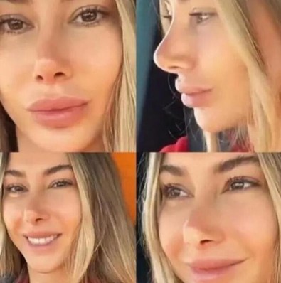Kalça estetiği geçiren Şeyma Subaşı hastanelik oldu! - Resim : 2