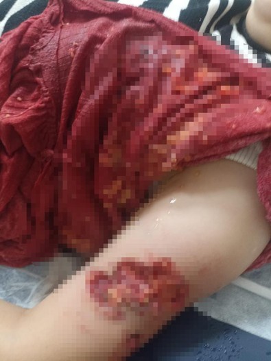 Başıboş köpekler 12 yaşındaki kız çocuğuna saldırdı! Derin yaralar ve doku kayıpları var! - Resim : 1