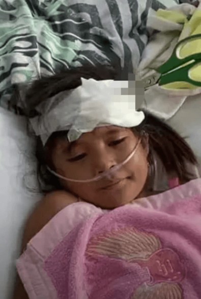 Kardeş kavgası feci bitti! Doktorları bile şaşkına çevirdi: Küçük kız 1 hafta kafasına saplanan makasla yaşadı - Resim : 1