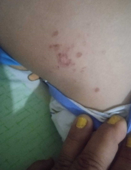 Antalya'da deniz enfeksiyonu alarmı! 9 yaşındaki çocuk hastanelik oldu: Vücudundaki lekelerle ilgili korkunç şüphe - Resim : 1