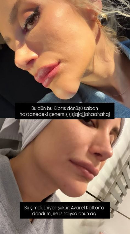 İrem Derici'nin çenesindeki şişlik olay oldu! Dolgu sanıldı, gerçek ortaya çıktı - Resim: 4