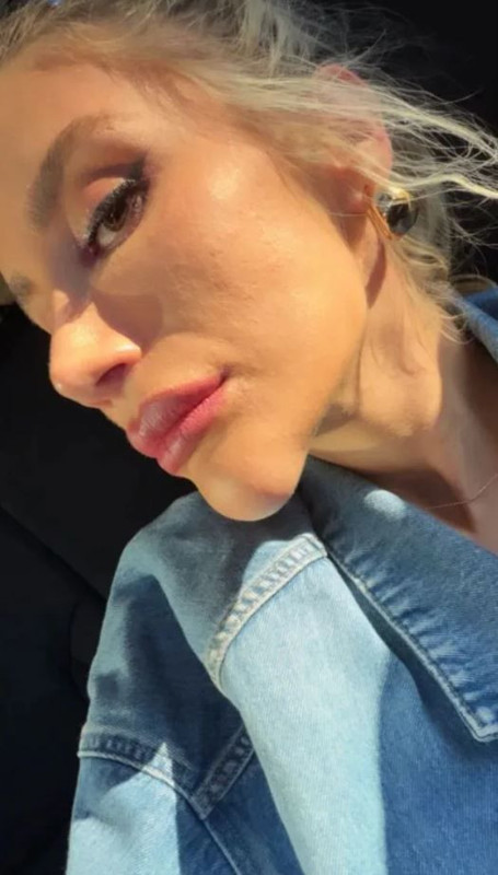İrem Derici'nin çenesindeki şişlik olay oldu! Dolgu sanıldı, gerçek ortaya çıktı - Resim: 3