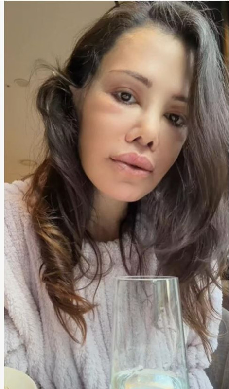 Yüz nakli operasyonu geçirmişti! Didem Ceran'dan kötü haber geldi - Resim: 5