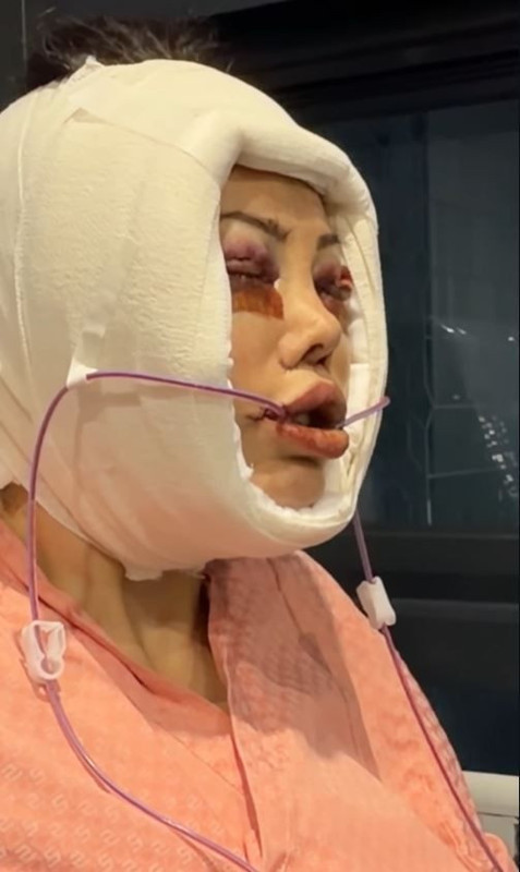 Yüz nakli operasyonu geçirmişti! Didem Ceran'dan kötü haber geldi - Resim: 2