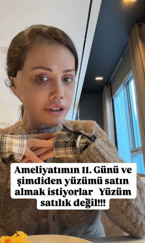 Eski Survivor yarışmacısı Didem Ceran 'yüz nakli' operasyonu geçirdi! Son halini görenler şaştı kaldı - Resim: 5