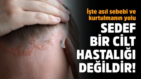 Sedef cilt hastalığı değildir! İşte kurtulmanın yolu