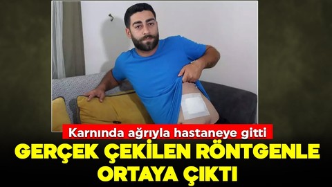 Karnında ağrıyla hastaneye gitti, gerçeği çekilen röntgenle öğrendi