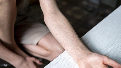 ABD'de kızamık vakaları artıyor