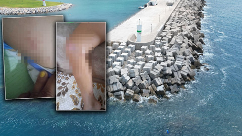 Antalya'da deniz enfeksiyonu alarmı! 9 yaşındaki çocuk hastanelik oldu: Vücudundaki lekelerle ilgili korkunç şüphe