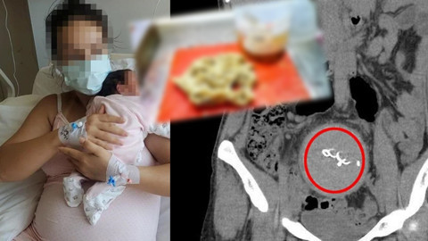 Doğumda unutuldu, iki yıl sonra ortaya çıktı! Gazlı bez ihmaline soruşturma