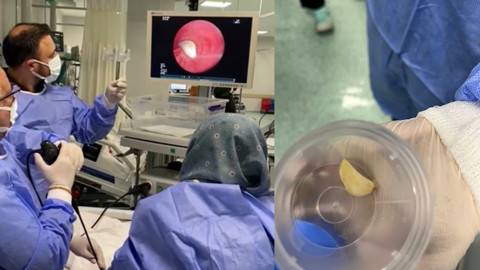 Doktorları da şaşırttı! Hastanın ciğerine kaçan cisim çıkartıldı