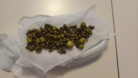 Safra kesesinden yüzlerce taş çıkarıldı!